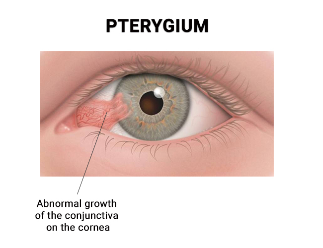 Pterygium