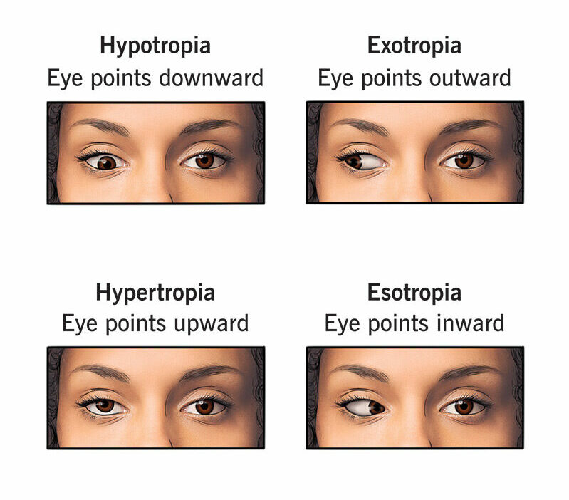 strabismus-eye-misalignment